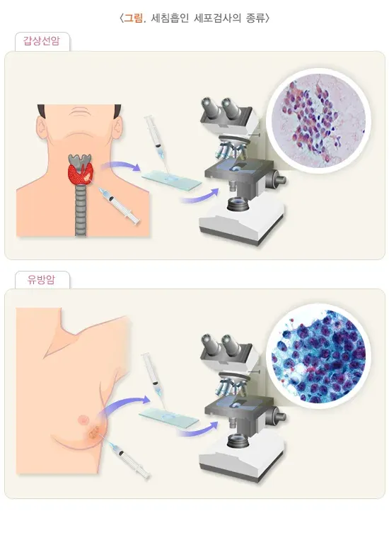 세포검사 검사 적응증 및 금기증 설명 이미지 1