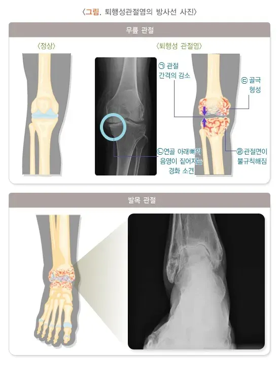골관절염 진단 및 검사 설명 이미지 1