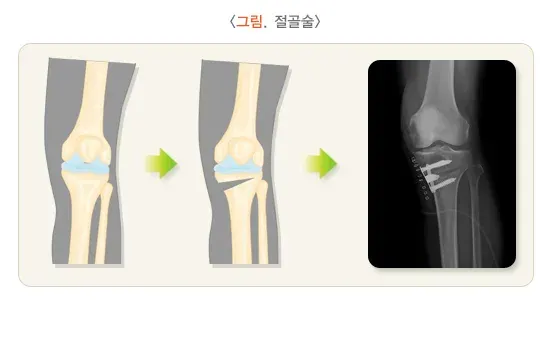 골관절염 치료 설명 이미지 3
