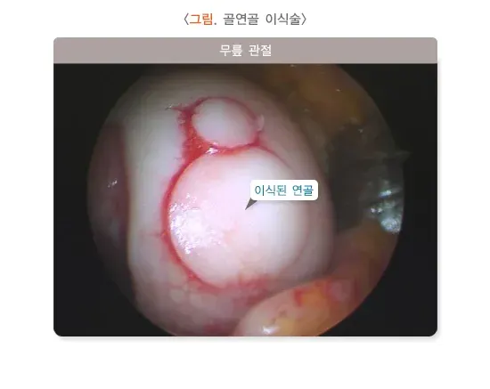 골관절염 치료 설명 이미지 2