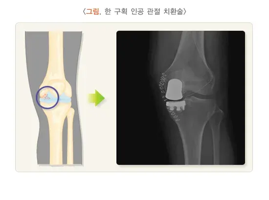 골관절염 치료 설명 이미지 5
