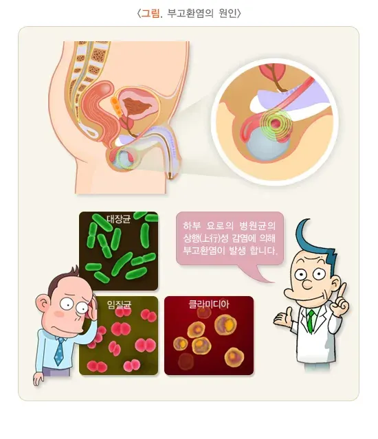 급성부고환염 원인 설명 이미지 1