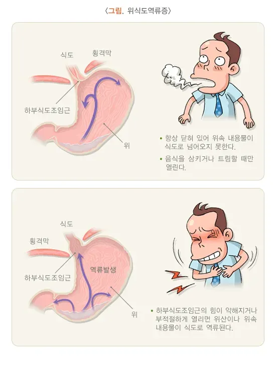 위식도역류질환 정의 설명 이미지 1