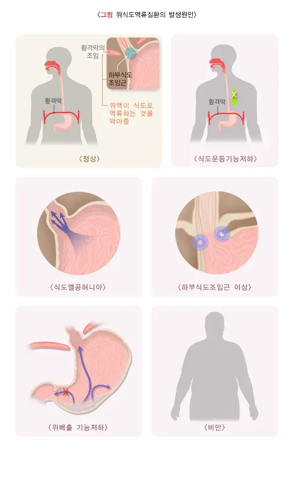 위식도역류질환 원인 설명 이미지 1