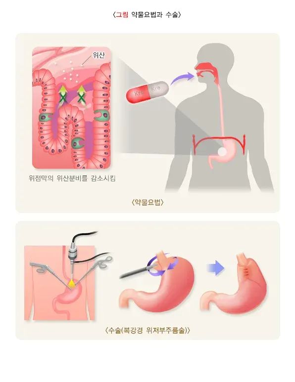 위식도역류질환 약물 치료 설명 이미지 1