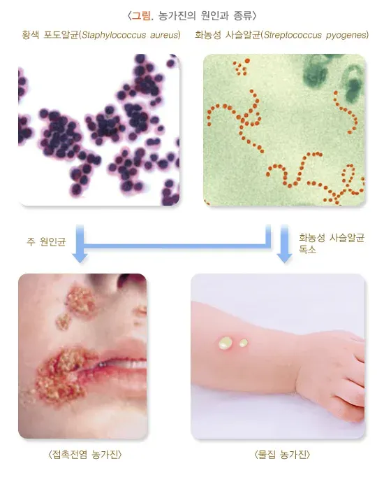 농가진 원인 설명 이미지 1