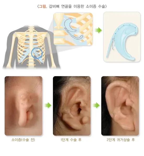 귀의 형태 이상(소이증) 비약물 치료 설명 이미지 1