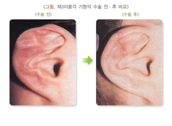 귀의 형태 이상(기타) 종류 설명 이미지 4