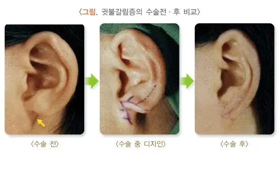 귀의 형태 이상(기타) 종류 설명 이미지 5
