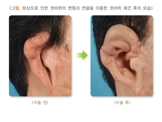 귀의 형태 이상(기타) 종류 설명 이미지 6