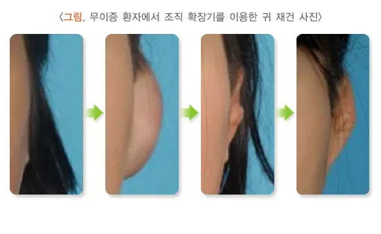 귀의 형태 이상(기타) 종류 설명 이미지 1