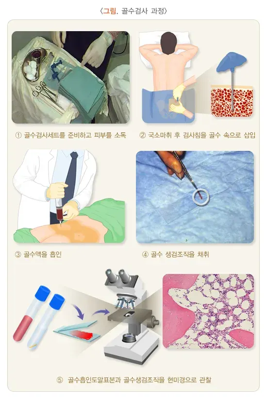 골수검사 주의사항 및 부작용 설명 이미지 1