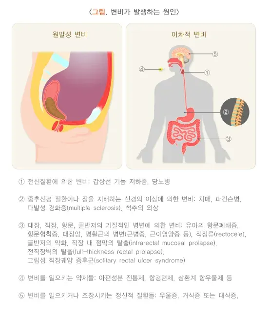 노인 변비 원인 설명 이미지 1