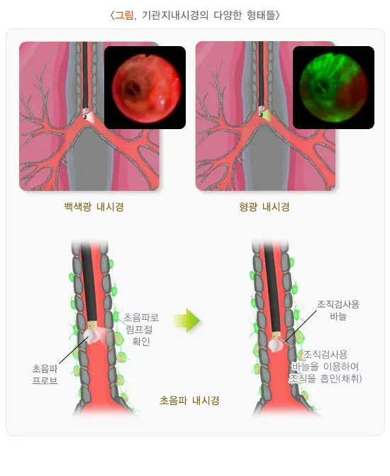 기관지 내시경 검사 검사 장비 설명 이미지 2