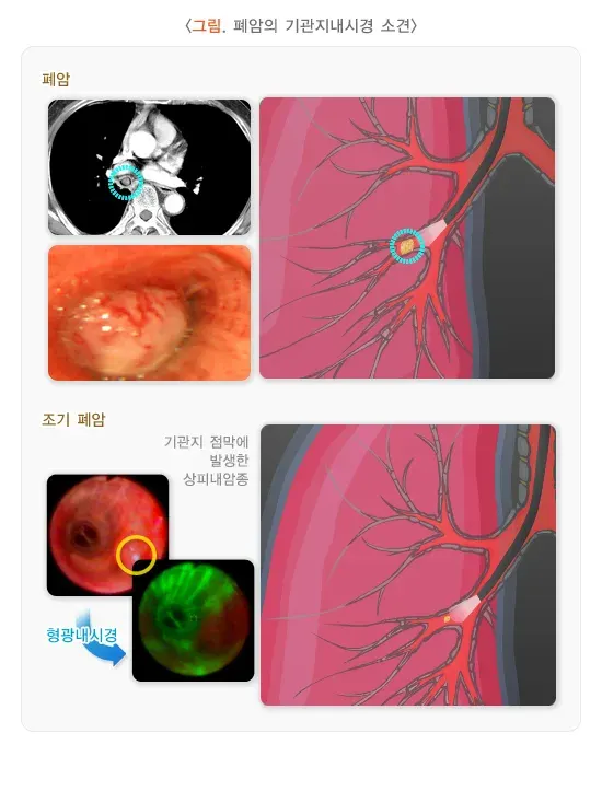 기관지 내시경 검사 검사 결과 해석 설명 이미지 3