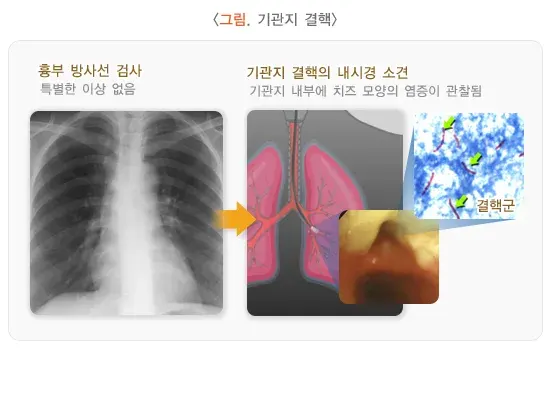 기관지 내시경 검사 검사 결과 해석 설명 이미지 2