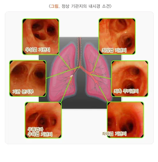 기관지 내시경 검사 검사 결과 해석 설명 이미지 1