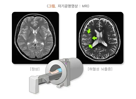 일과성 허혈 발작 진단 및 검사 설명 이미지 2