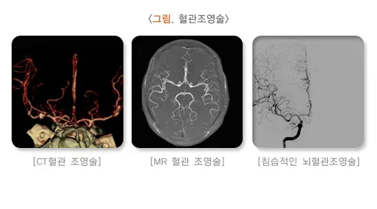 일과성 허혈 발작 진단 및 검사 설명 이미지 3