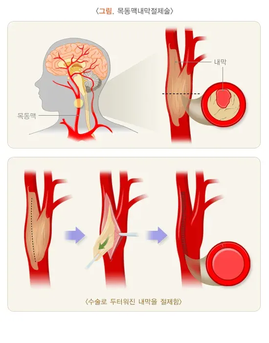 일과성 허혈 발작 비약물 치료 설명 이미지 1