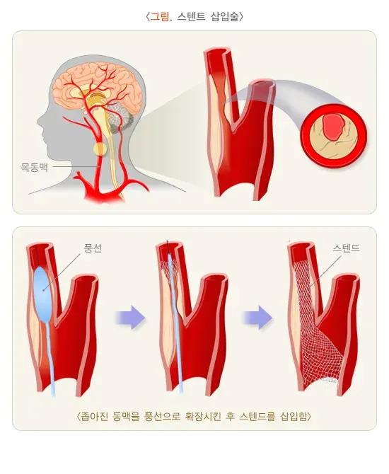 일과성 허혈 발작 비약물 치료 설명 이미지 2