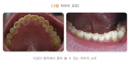 이갈이 진단 및 검사 설명 이미지 2