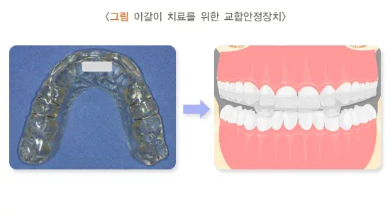 이갈이 비약물 치료 설명 이미지 1