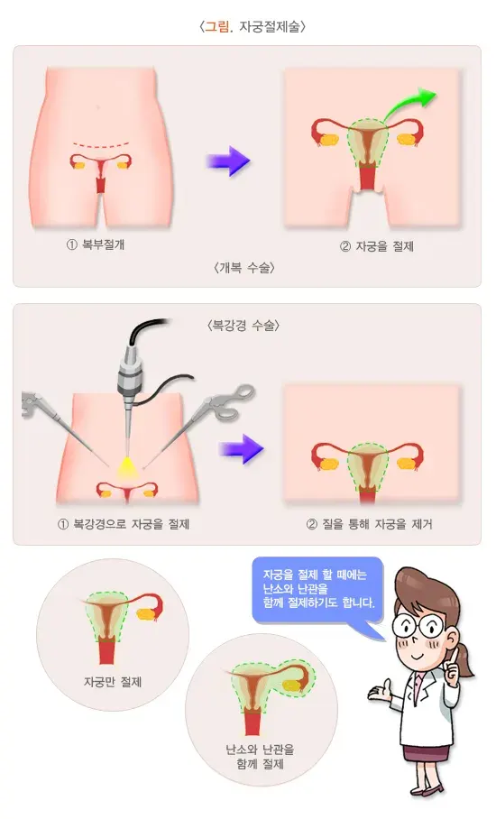 자궁근종 치료 설명 이미지 2