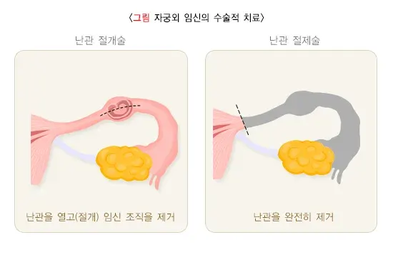 자궁외 임신 비약물 치료 설명 이미지 1