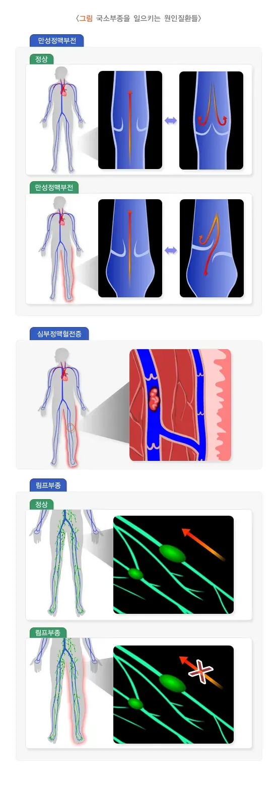 노인 부종 관련 질환 설명 이미지 1