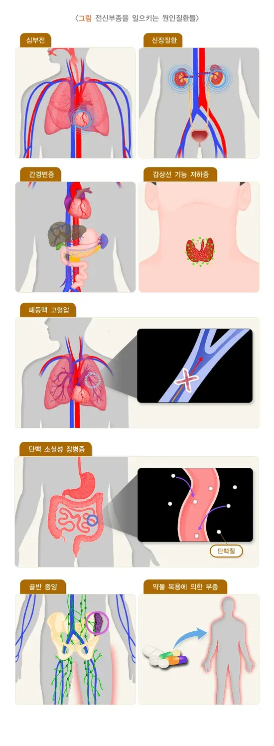 노인 부종 관련 질환 설명 이미지 2
