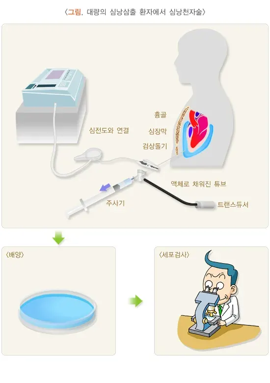 심낭염(만성 심낭삼출) 치료 설명 이미지 1