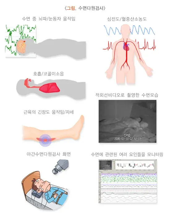 수면무호흡증 진단 및 검사 설명 이미지 1