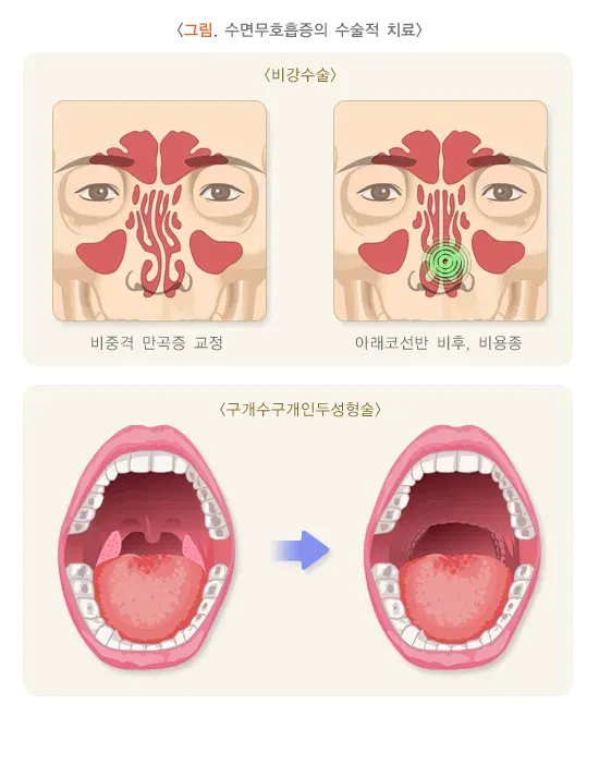 수면무호흡증 비약물 치료 설명 이미지 2