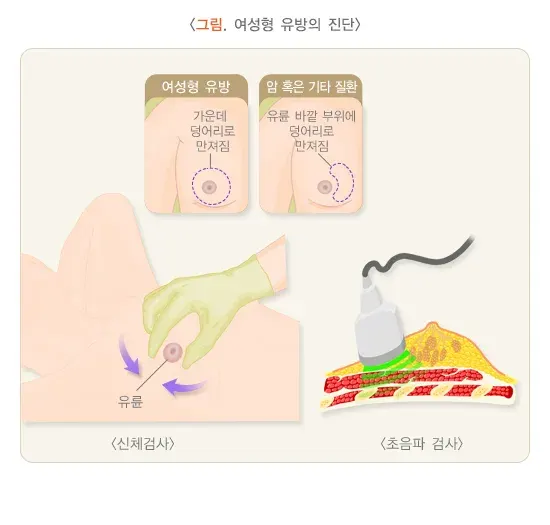 여성형유방 진단 및 검사 설명 이미지 1