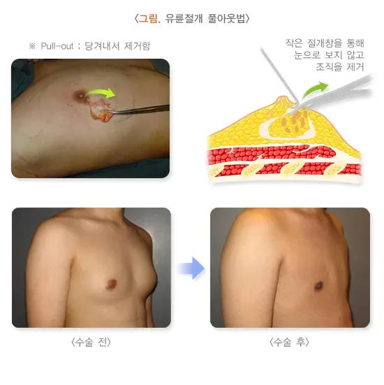 여성형유방 비약물 치료 설명 이미지 2