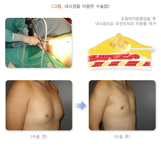 여성형유방 비약물 치료 설명 이미지 4