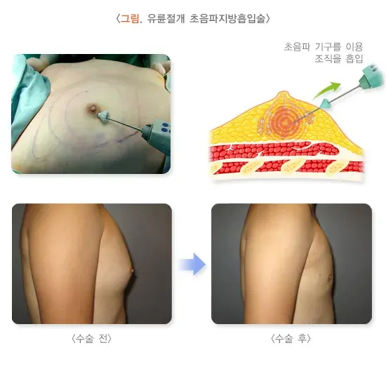여성형유방 비약물 치료 설명 이미지 3