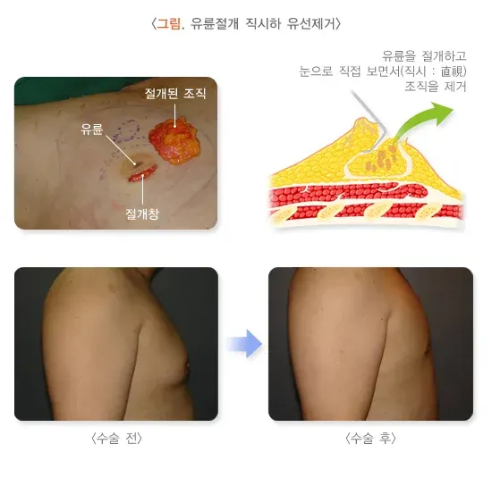 여성형유방 비약물 치료 설명 이미지 1