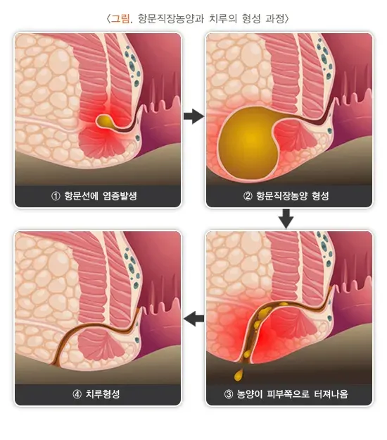 항문직장농양과 치루 정의 설명 이미지 2