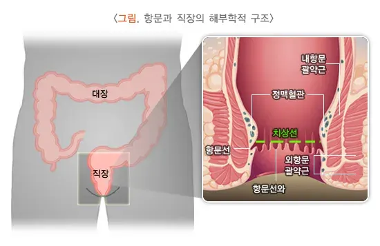 항문직장농양과 치루 정의 설명 이미지 1