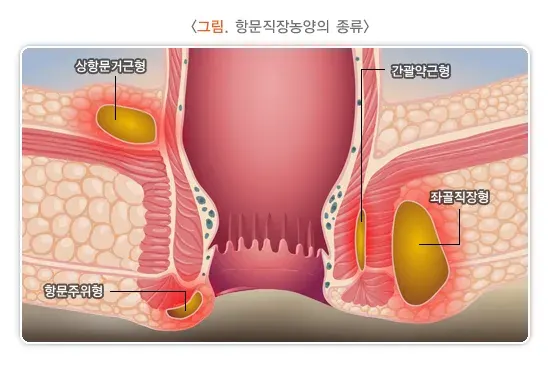 항문직장농양과 치루(항문직장농양) 종류 설명 이미지 1