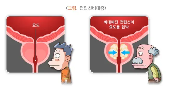 전립선비대증 정의 설명 이미지 1