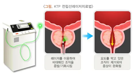 전립선비대증 비약물 치료 설명 이미지 2