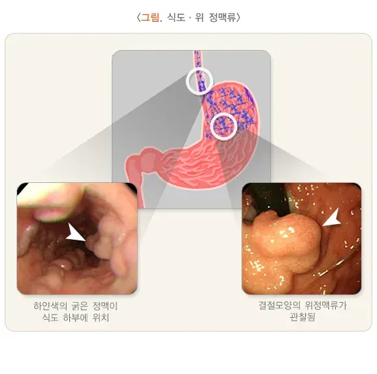 토혈(성인) 원인 설명 이미지 2