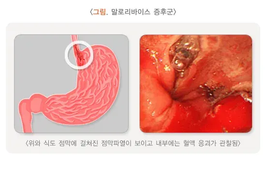토혈(성인) 원인 설명 이미지 3