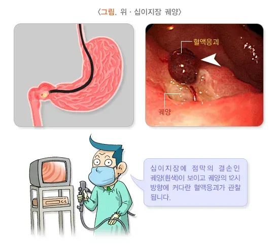 토혈(성인) 원인 설명 이미지 1