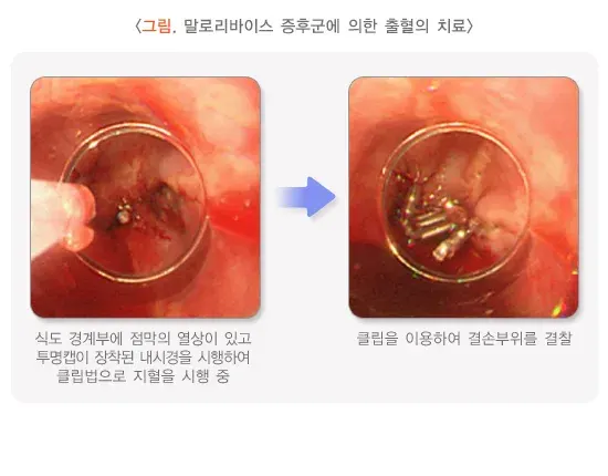 토혈(성인) 치료 설명 이미지 3