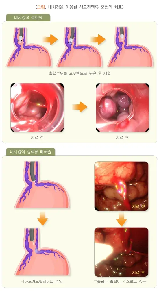 토혈(성인) 치료 설명 이미지 2