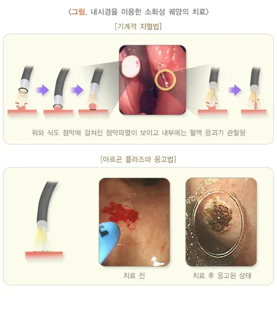토혈(성인) 치료 설명 이미지 1